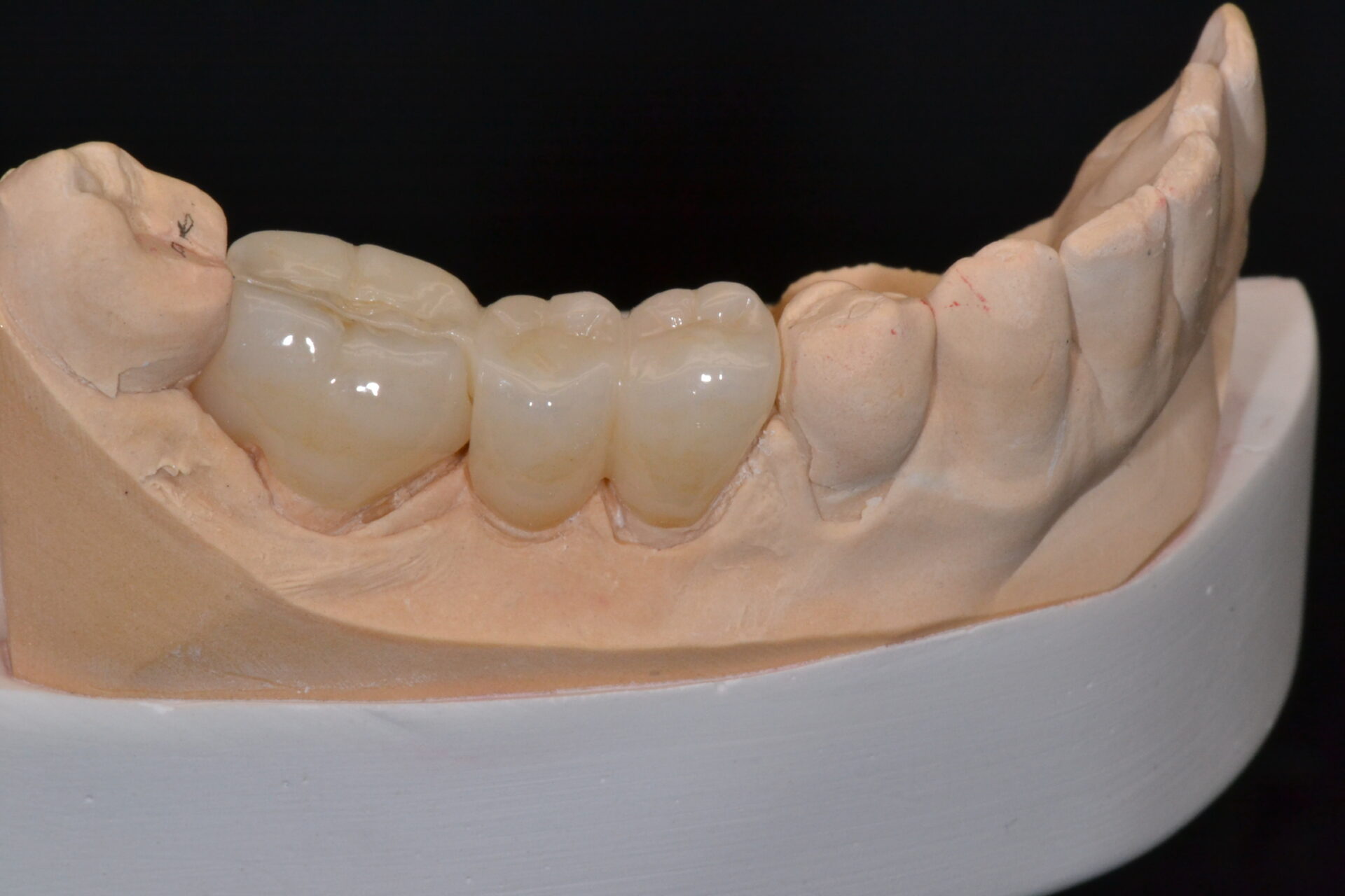 A dental cast with several implants