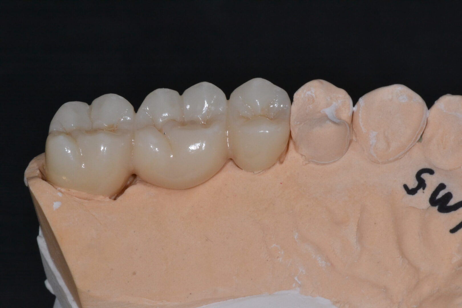 Three dental implants on a cast