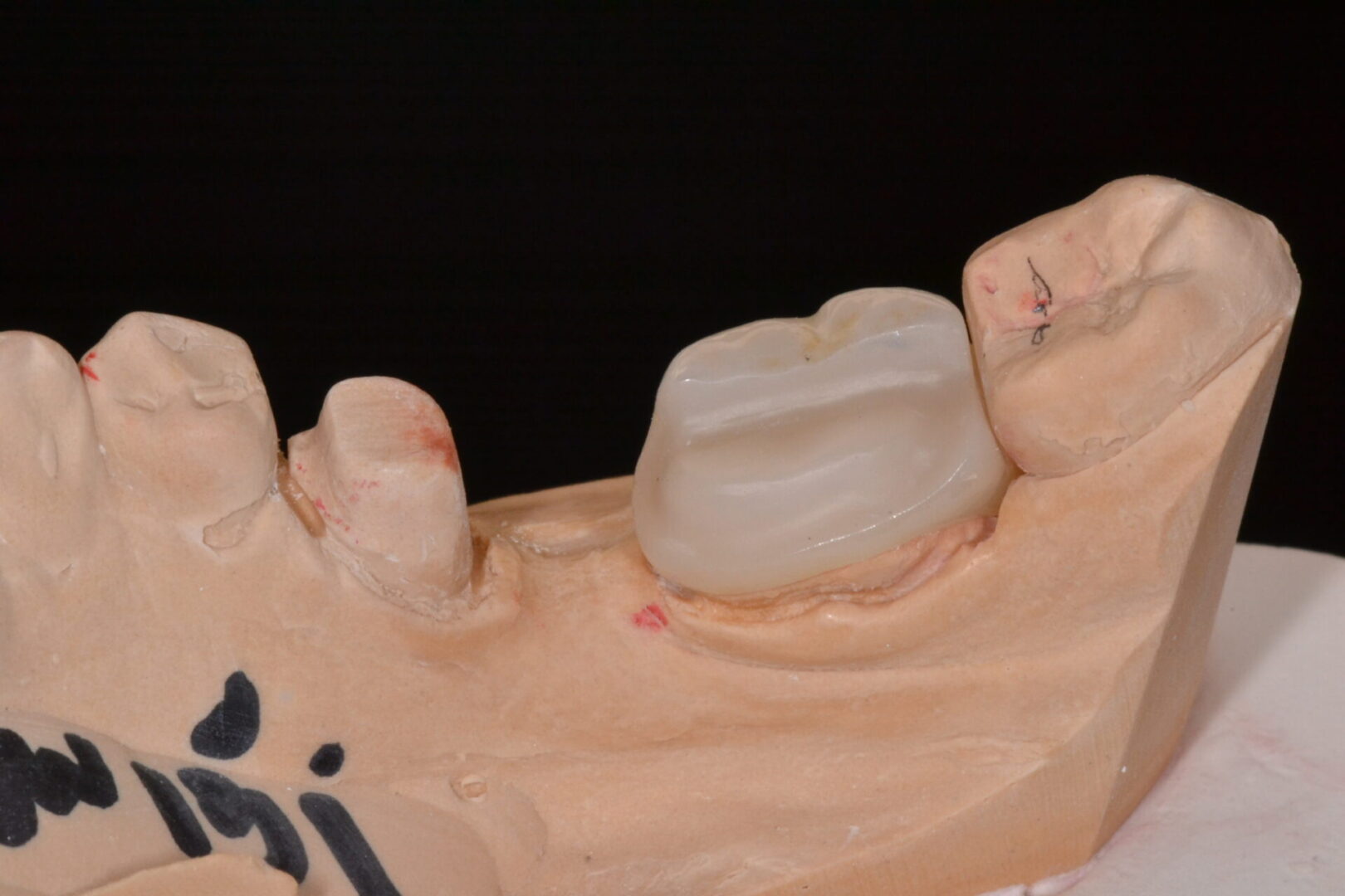 One implant placed on a dental cast