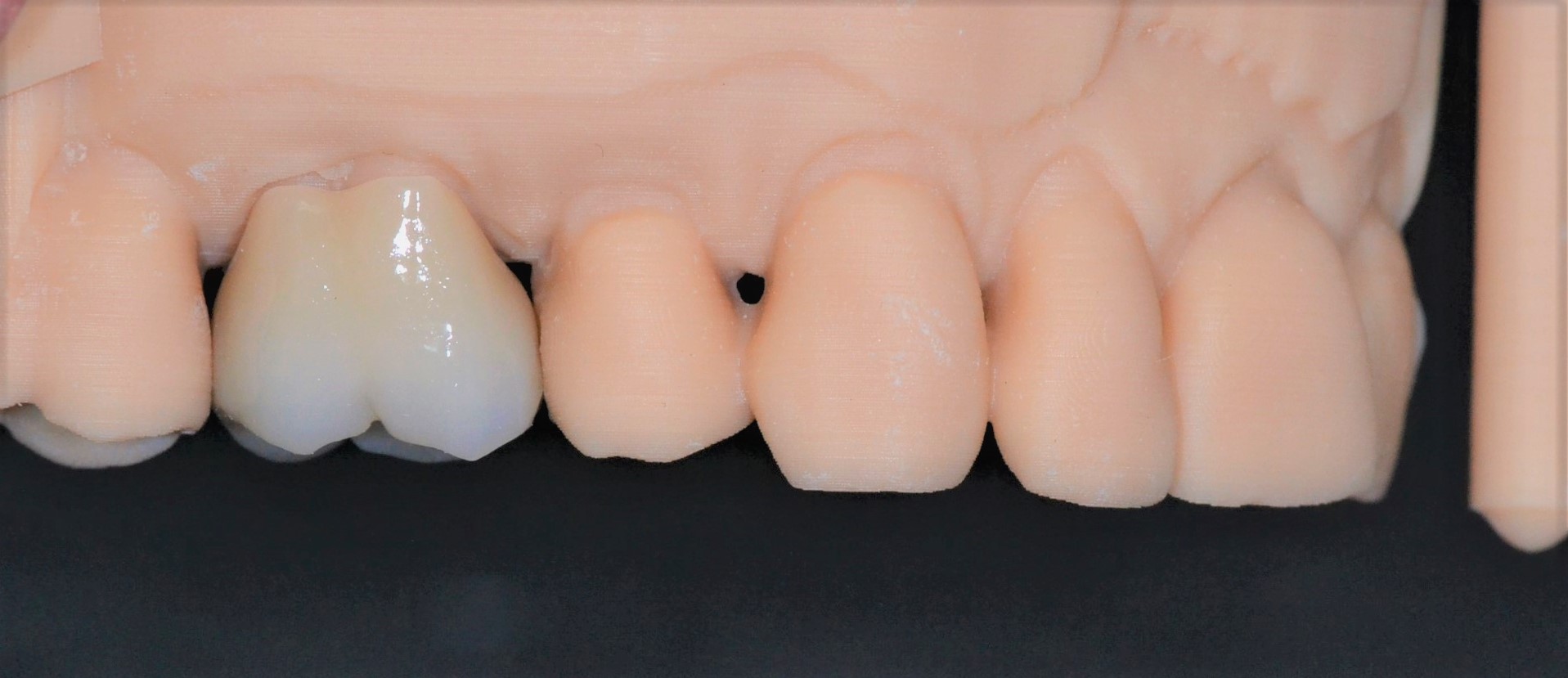 An implant of an upper tooth fitted in a cast