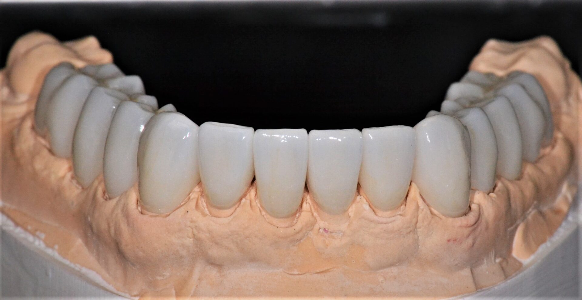 A set of lower teeth implants on a dental cast