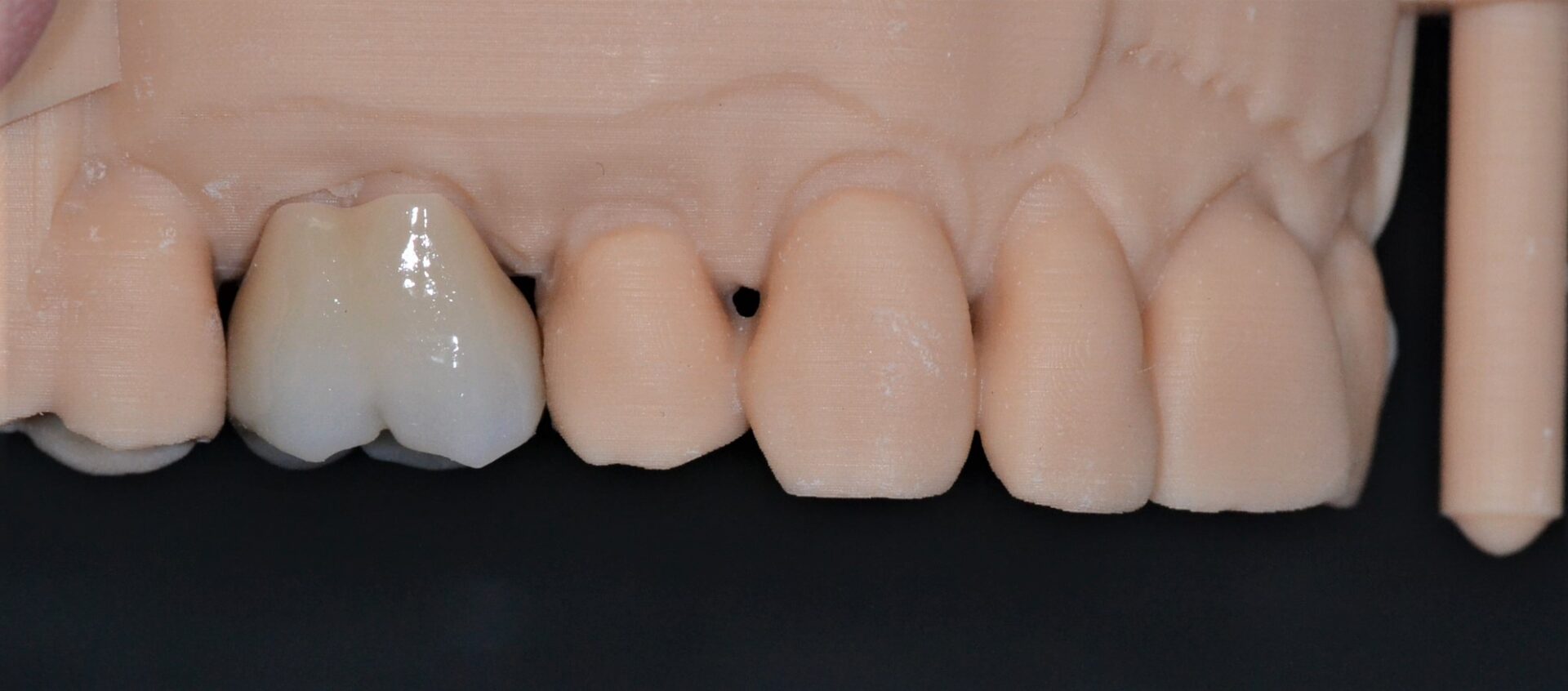 One monolithic dental implant