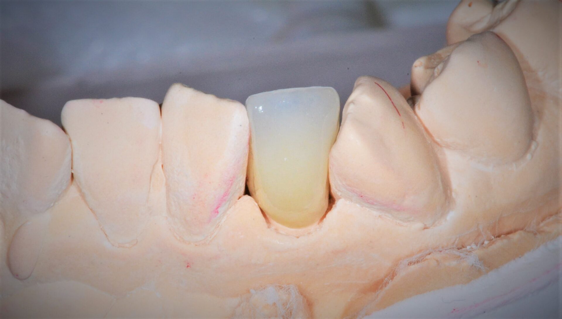 A lower tooth implant on a cast