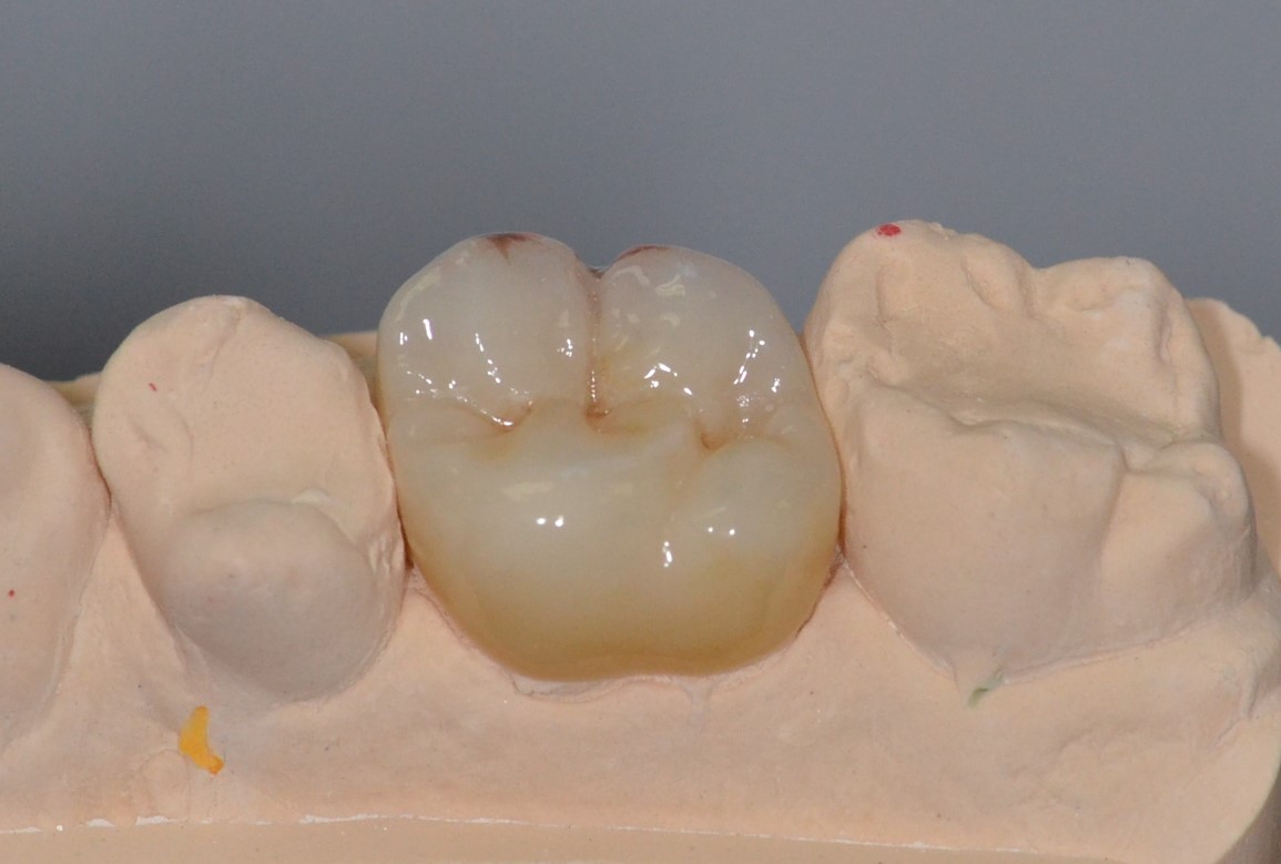 Close look at a dental implant on a cast