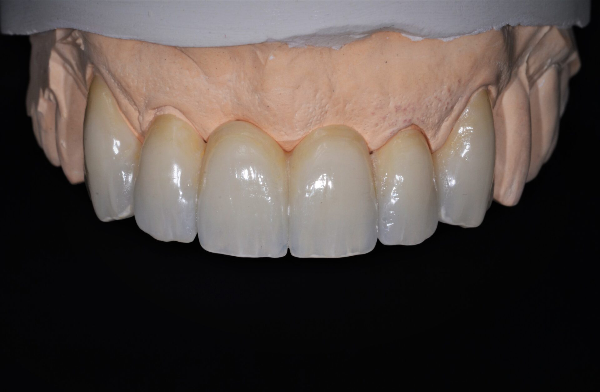 Zirconia Bridge Dental Implant