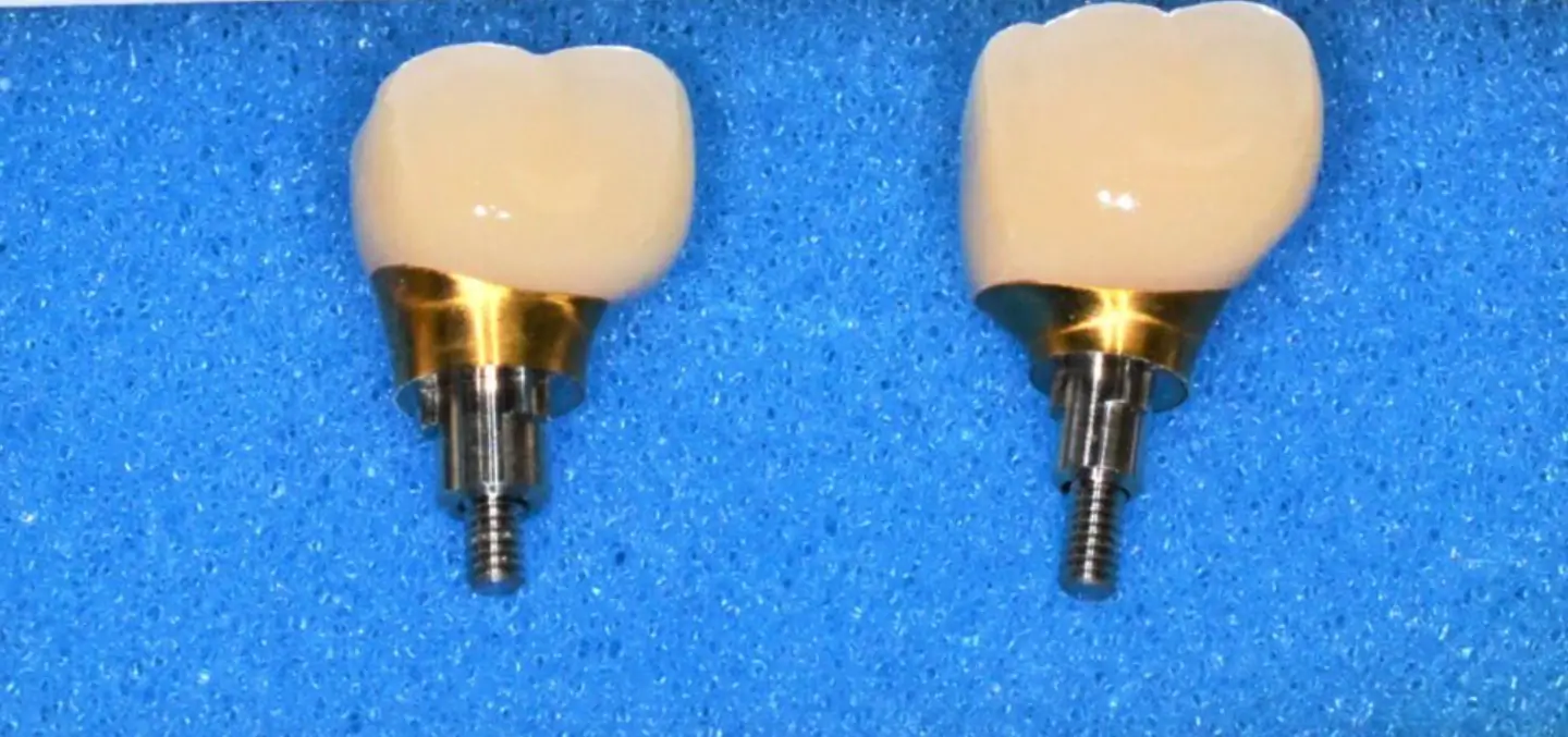 Two artificial teeth for dental implant